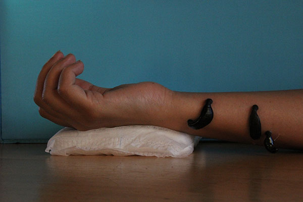 Leech Therapy/Hirudo Therapy